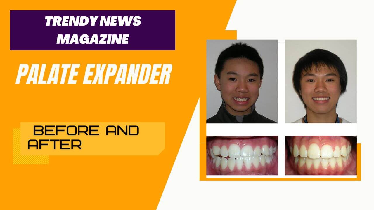 Palate Expander Before and After